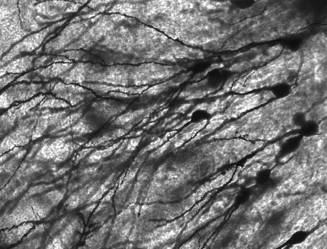 Image of Golgi stained neurons in the dentate gyrus of an epilepsy patient.